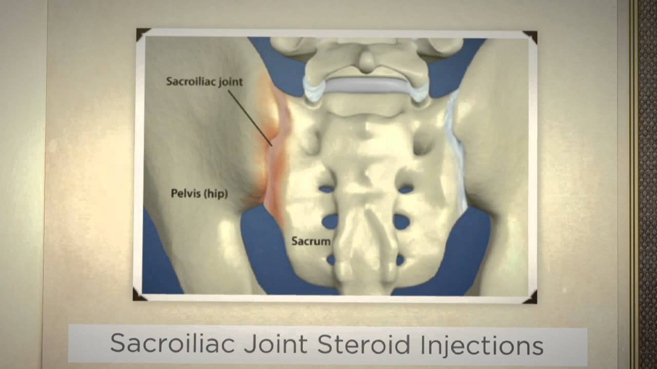 Steroid Injection